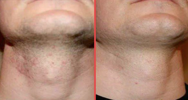 Shaving Bumps